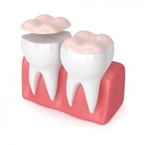 3d render of dental onlay