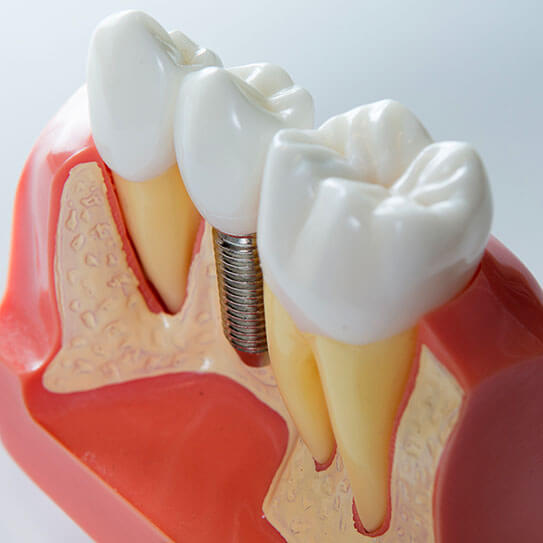 dental implant same-day crown