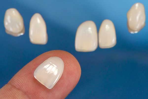 Dental Veneers Ready To Be Applied