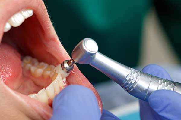 Closeup of patient mouth receiving dental cleaning