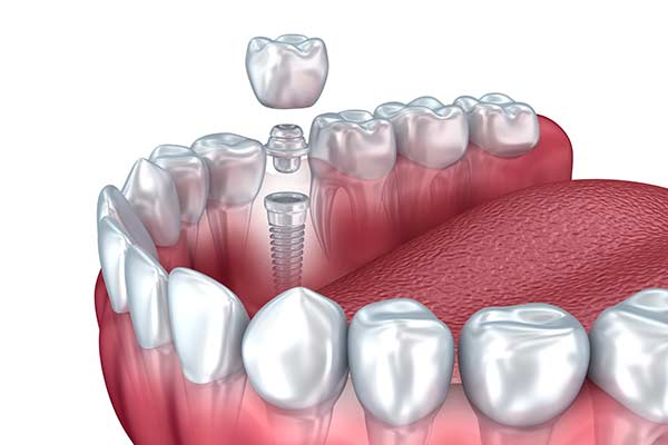 Dental Implant