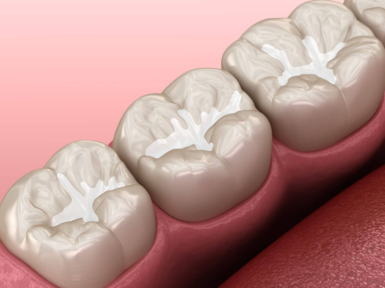 Man examined for dental sealants.