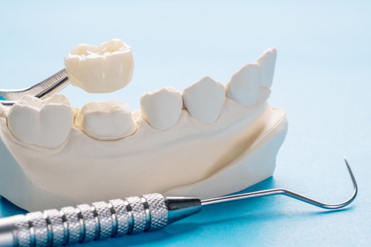 Single dental crown and model with dental instruments