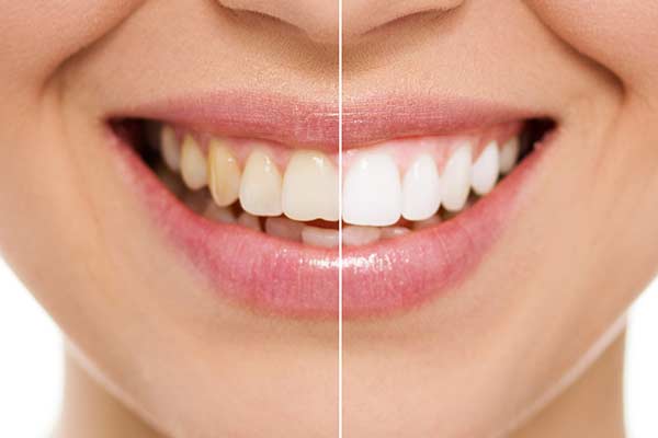 Before And After Teeth Whitening Service
