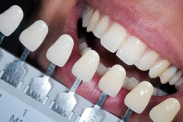 Composite Fillings In Various Shades Compared To Teeth