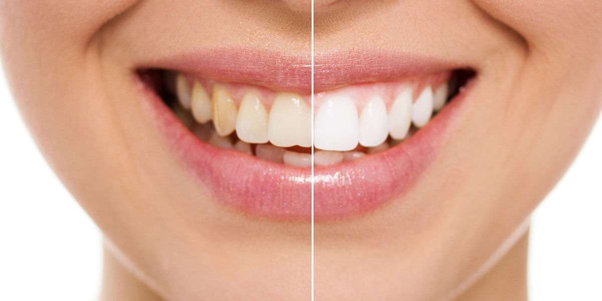 Woman’s smile before and after whitening.